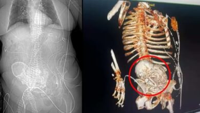 feto calcificado em idosa