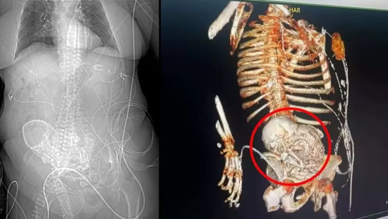 feto calcificado em idosa